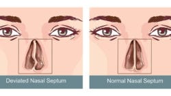 Deviated Septum - Sinus Surgery Center | UCI ENT | Sinus Surgery ...