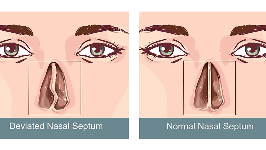 medical-concept-of-deviated-septum-UCI-Sinus-Surgery-Center-1