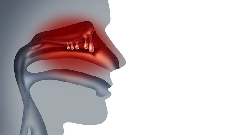 Nasal Polyps - Sinus Surgery Center | UCI ENT | Sinus Surgery Specialists