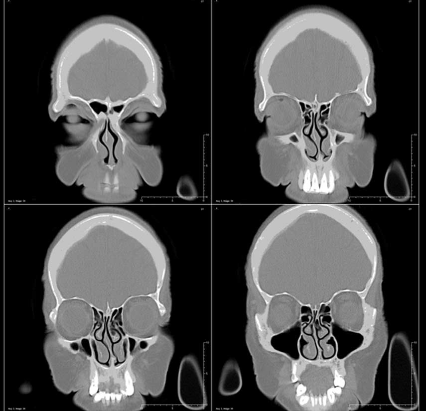 medical-imaging-prior-to-revision-sinus-surgery-1-UCI-Sinus-Surgery-Center